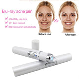 Skincare Beauty Pen | Wrinkle Removal Treatment Device